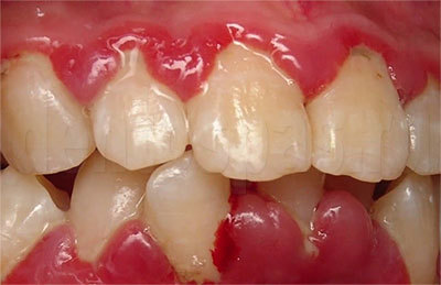 Выпал передний зуб, что делать: возможные причины и способы восстановления