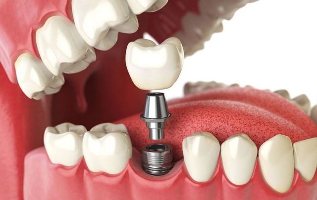 Что такое депульпирование зуба, когда и в каком порядке проводится данная процедура