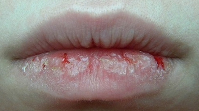 Болячка на внутренней стороне губы: лечение и профилактика