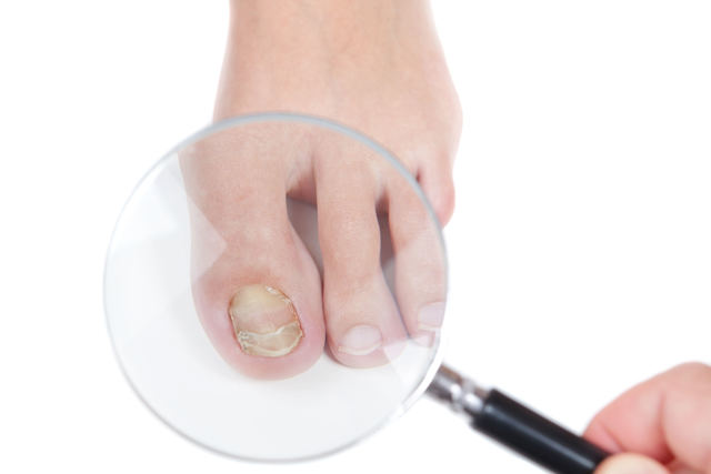 Почему образуется ногтевой грибок на ногах: лечение, признаки, симптомы болезни и профилактика