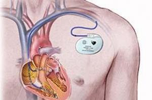 Кардиостимулятор сердца: отзывы, установка, жизнь до и после