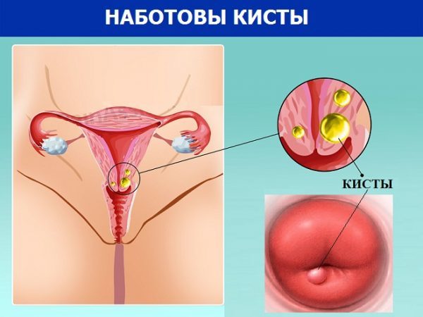 Эндометриоидная киста шейки матки: угроза бесплодия или нет