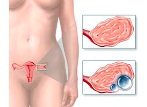 Эндометриоидная киста шейки матки: угроза бесплодия или нет