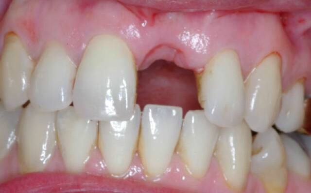Свищ после удаления зуба - причины образования, симптоматическая картина, методы диагностики, лечения