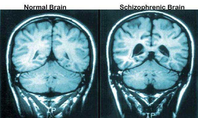 Параноидная шизофрения: симптомы, характеристика, терапевтическое воздействие