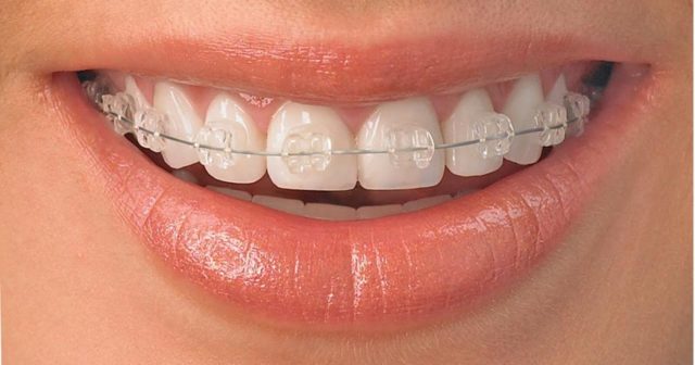 Зубные пластины: общие сведения, виды, показания к применению, преимущества и недостатки
