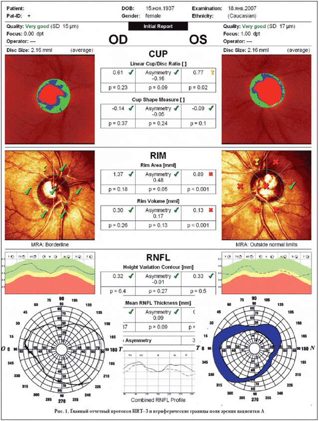 Экскавация диска зрительного нерва: описание разновидностей