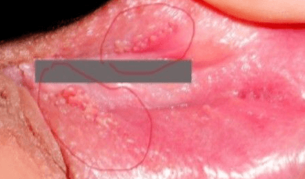 Язвы на половых губах – возможные причины и диагностика