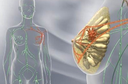 Онкологии грудной железы: симптомы, общие и особые признаки