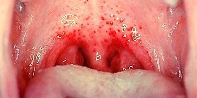 Солевой раствор для полоскания горла: приготовление, рецептура, лечебные свойства и сфера применения