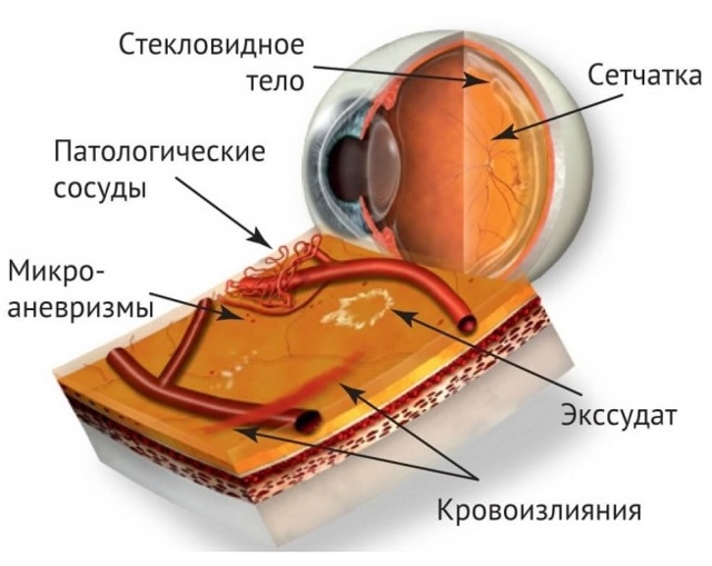 Разрыв сетчатки глаза, симптомы и причины заболевания