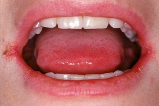 Как лечить заеду в углу рта? Причины и способы избавления