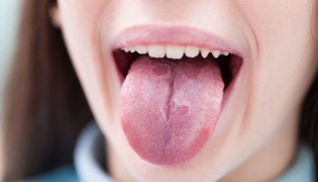 Как поставить диагноз по симптомам, о каких болезнях может рассказать нам язык