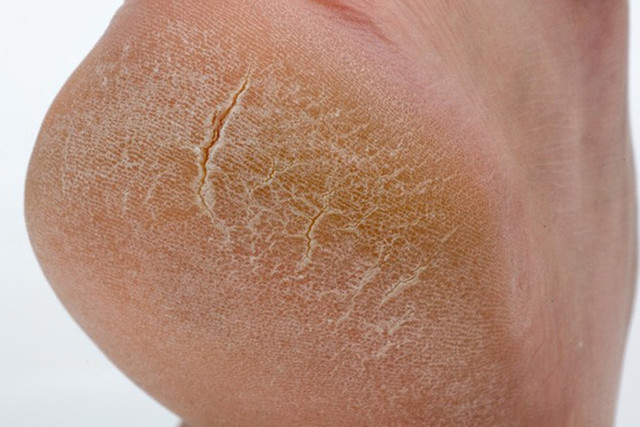 Почему появляются трещины на пятках - причины сухости и ороговения кожи, диагностика и способы лечения