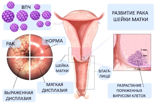 Что такое папилломавирусная инфекция: симптомы у женщин, лечение, какую опасность она несет