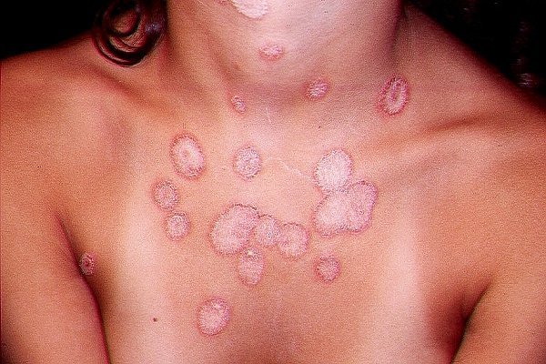Лечение микоза  кожи медикаментозными и народными методами