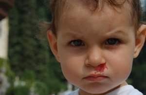 Частые носовые кровотечения у детей: причины, симптомы, первая помощь, методы лечения, профилактика