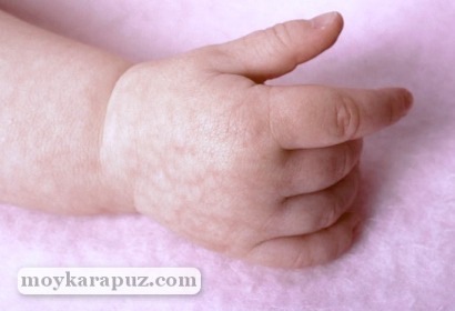 Причины мраморной кожи у новорожденного, методы диагностики и лечения