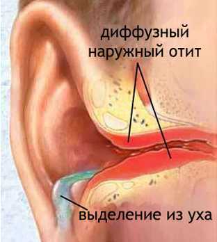 Признаки отита у грудничка - возрастные особенности, первая помощь при воспалении ушей
