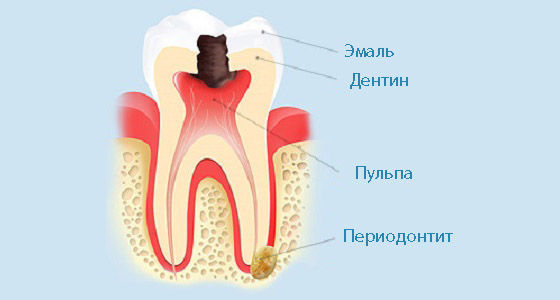 Лечение воспаления корня зуба консервативными способами и средствами народной медицины