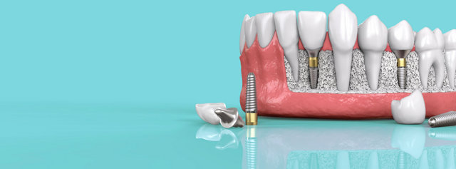 Зубной имплантат: цены, методы имплантации, что такое имплантация под ключ, виды имплантатов