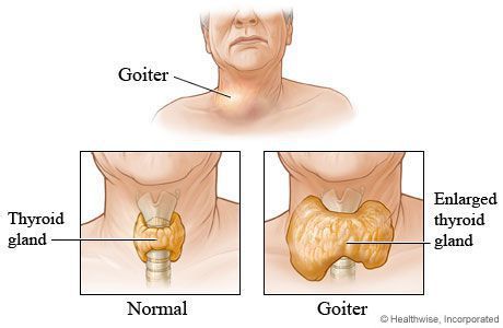 Что такое зоб щитовидной железы: причины, признаки, осложнения, методы лечения и профилактики