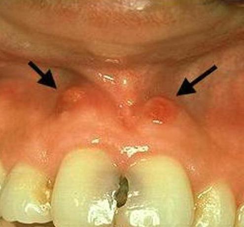 Как быстро избавиться от флюса без помощи стоматолога