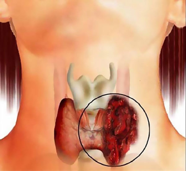 Симптомы проблем щитовидной железы - что делать при возникновении, опасность болезней щитовидки