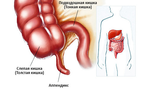 Как получить аппендицит: возможные причины и провоцирующие факторы воспаления аппендикса