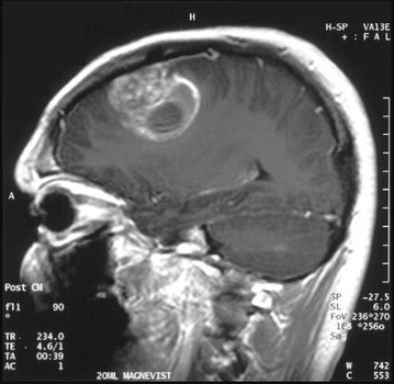 Симптомы опухоли мозжечка - описание болезни, клинические проявления, методы диагностики и лечения