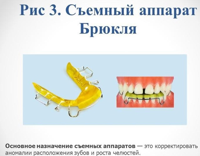 Зубные пластины: общие сведения, виды, показания к применению, преимущества и недостатки
