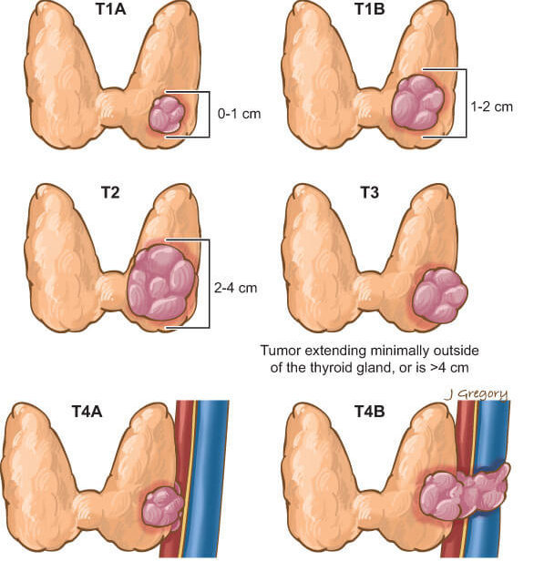 Узелки на щитовидной железе: описание, виды, причины развития, симптоматические проявления, лечение