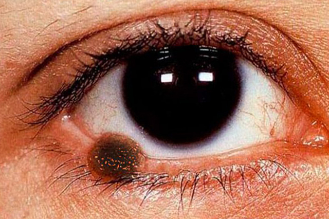 Опухоль на веке глаза - основные виды, клинические проявления, методы диагностики, лечение