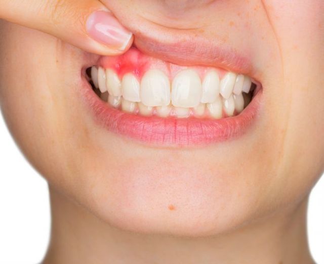 Как быстро избавиться от флюса без помощи стоматолога
