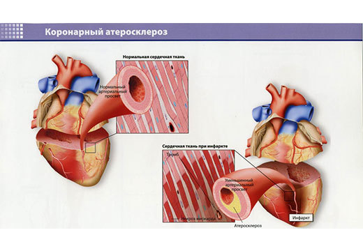 Что представляет собой атеросклероз аорты коронарных артерий