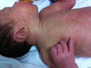 Причины мраморной кожи у новорожденного, методы диагностики и лечения
