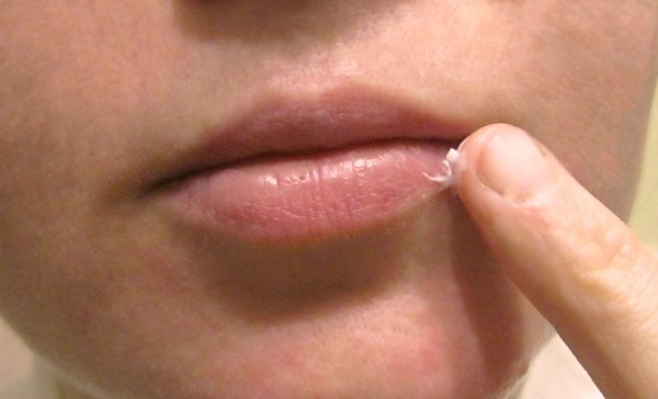 Как лечить герпес на губах при беременности - угроза будущей маме и эмбриону