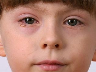 Лечение вирусного конъюнктивита у детей: симптоматика и пути заражения