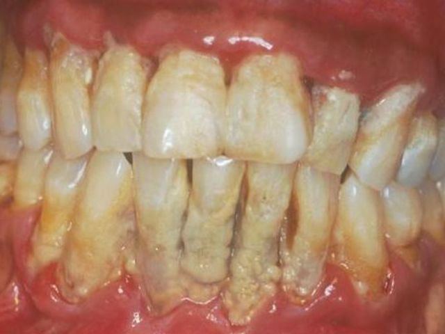Камни на зубах: причины, методы распознавания, каким образом можно избавиться
