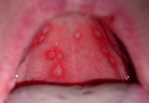 Ожог слизистой рта: симптомы и первая помощь