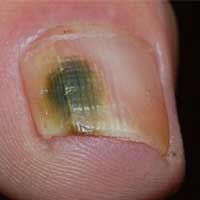 Лечение ногтевого грибка на ногах народными средствами, сущность данного недуга и его опасность
