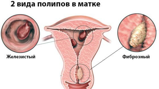 Полип во время беременности - причины появления, виды патологии и возможные осложнения