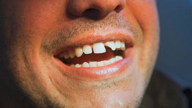 Можно ли укрепить шатающийся зуб, какие способы устранения проблемы наиболее эффективные