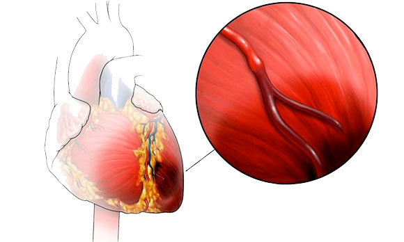 Симптомы стенокардии сердца, чем она опасна