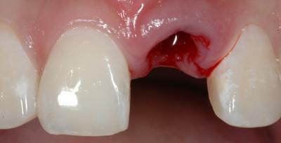 Сколько может болеть десна после удаления зуба: первопричины