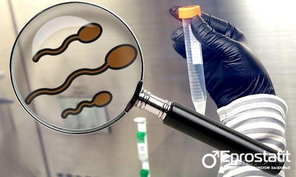 Сперма коричневого цвета - причины, возможные заболевания и их признаки, методы лечения