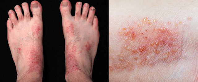 Как лечить дерматит на ногах: терапия медикаментами и рецептами альтернативной медицины