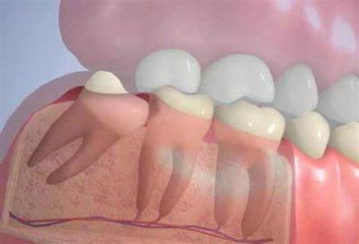 Симптомы зуба мудрости, процедура удаления и восстановления десны