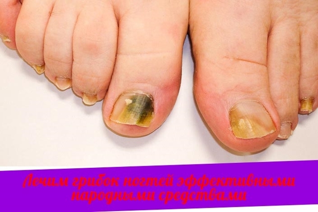 Лечение ногтевого грибка на ногах народными средствами, сущность данного недуга и его опасность