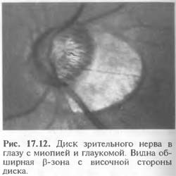 Экскавация диска зрительного нерва: описание разновидностей